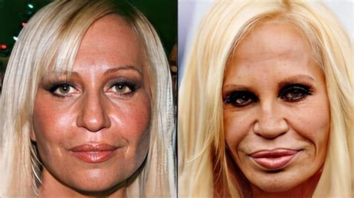 Bad Celebrity Plastic Surgery: A Cautionary Tale