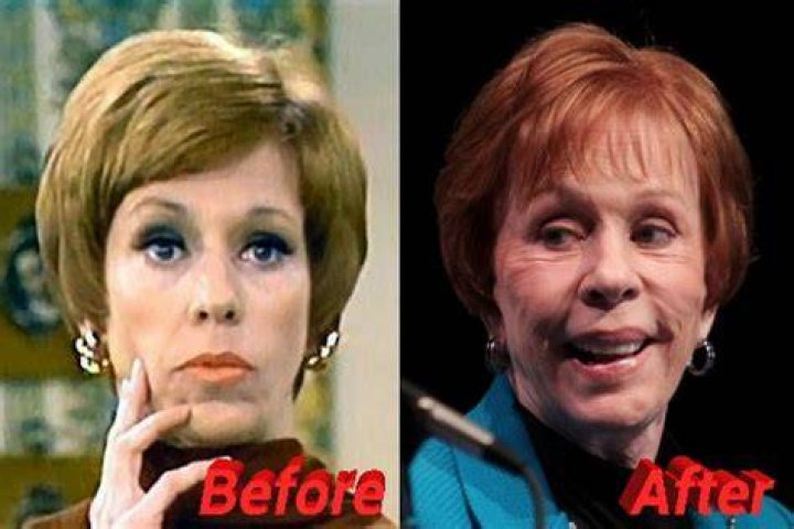 Did Carol Burnett Have a Facelift? Unveiling the Truth Behind the Iconic Comedian's Look