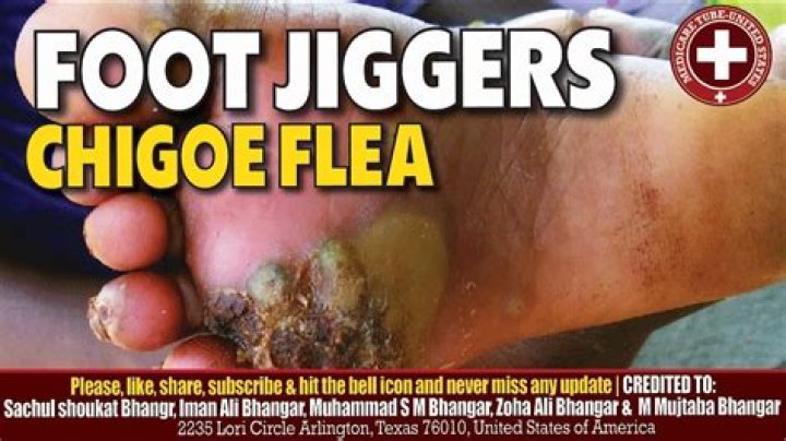 Effective Jiggers Removal: A Complete Guide to Elimination and Prevention