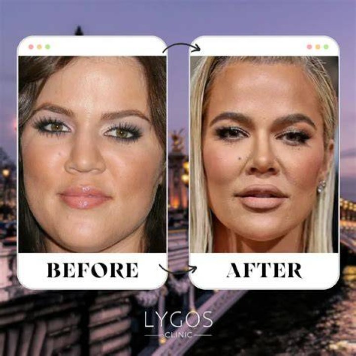Exploring Khloe Kardashian's Nose: Transformation and Beauty Journey