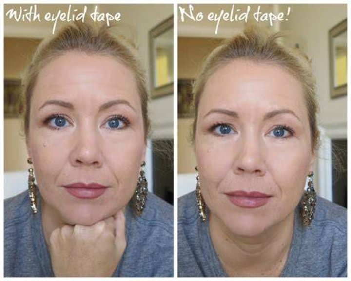 Eyelid Tape Ruined My Eyes: The Hidden Dangers and Solutions