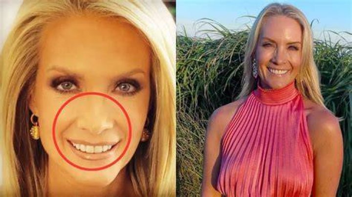Get the Scoop: Dana Perino's Nose Analysis and Enhancements