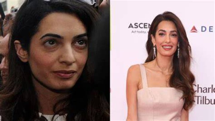 Has Amal Clooney Had Plastic Surgery? Unveiling the Truth