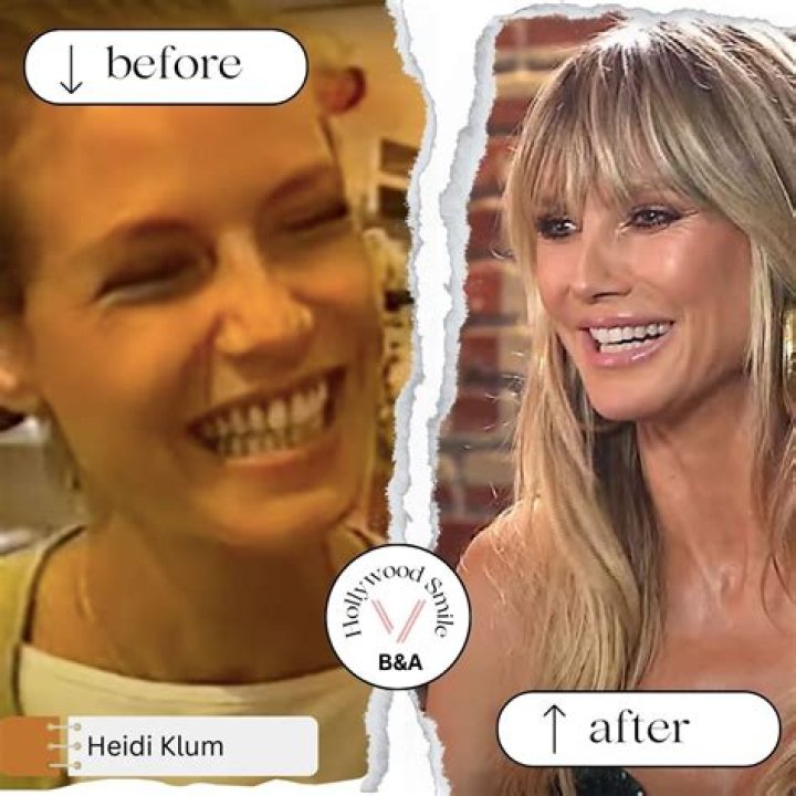 Heidi Klum Plastic Surgery: A Comprehensive Look at the Supermodel's Transformation