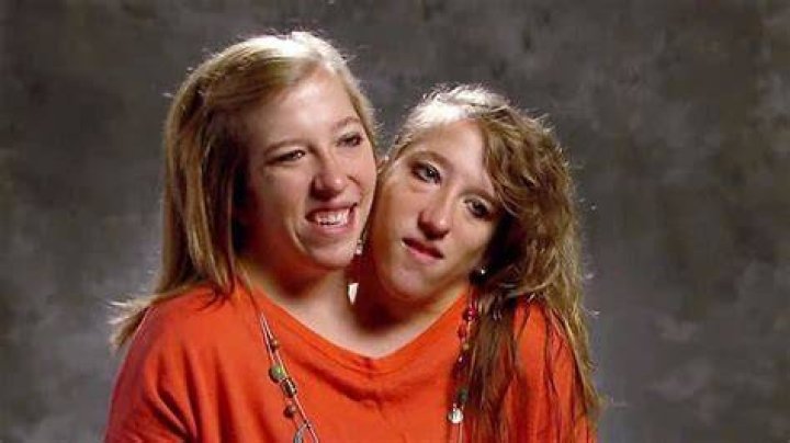 Hensel Twins Net Worth: A Comprehensive Insight into Their Financial Journey