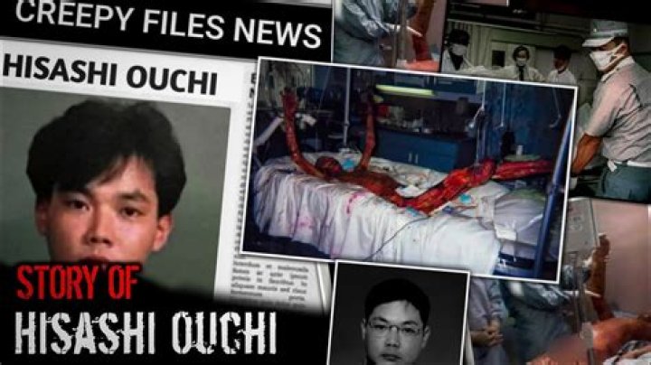 Hisashi Ouchi Real Image: The Tragic Story of a Nuclear Accident Victim