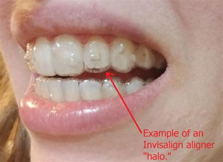 Invisalign Invisible Orthotics Instructor: Dr. Yong Ni