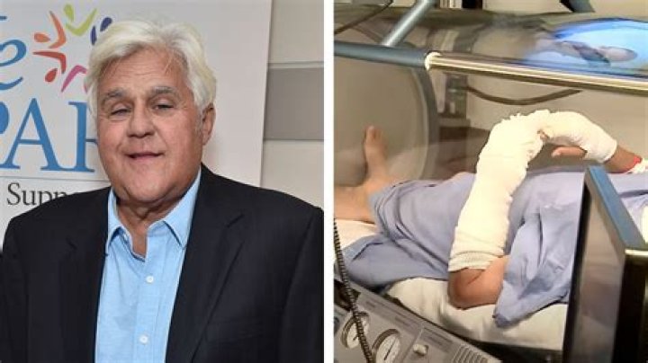 Jay Leno's Recovery: How Is Jay Leno Doing After His Accident?