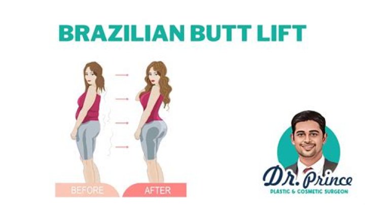 Kardashian BBL: The Definitive Guide to the Kardashian Influence on Brazilian Butt Lifts