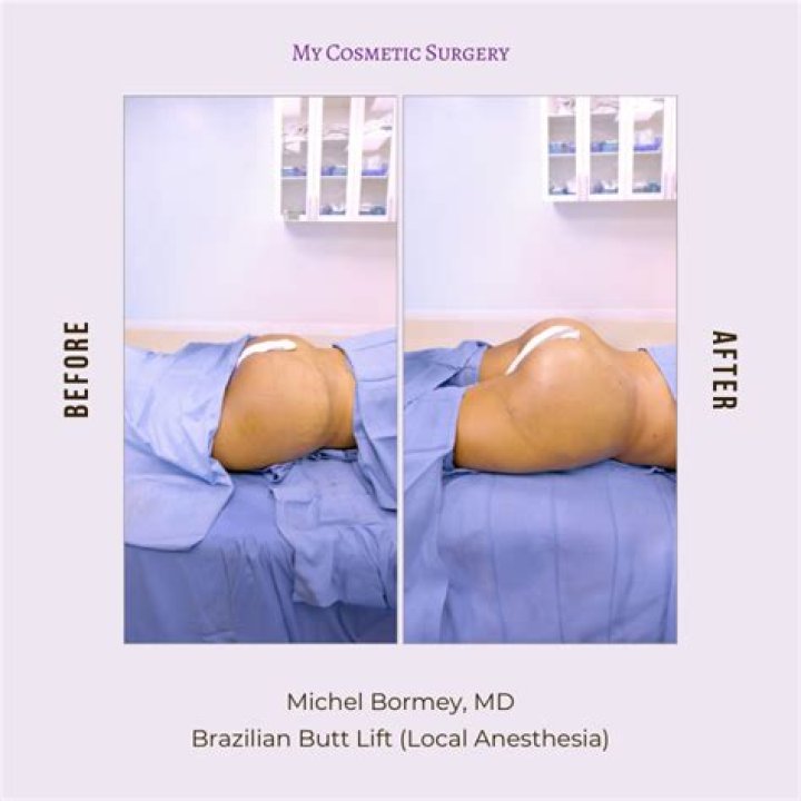 Kim Kardashian and the Brazilian Butt Lift: A Comprehensive Guide