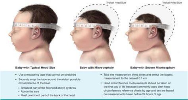 Macrocephaly Treatment: Understanding and Managing Enlarged Head Circumference
