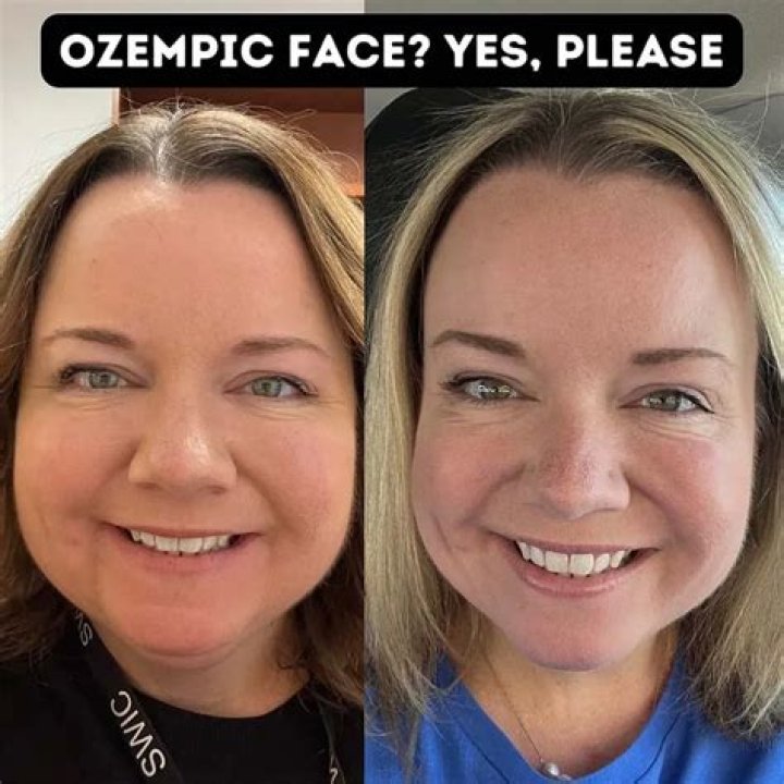 Ozempic Face: Before and After Pictures Explained