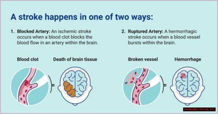 Pioneer Woman Stroke: Understanding the Impact and Recovery