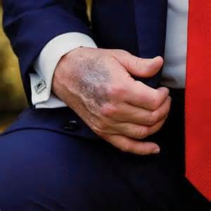 President Trump's Bleeding: A Deeper Look