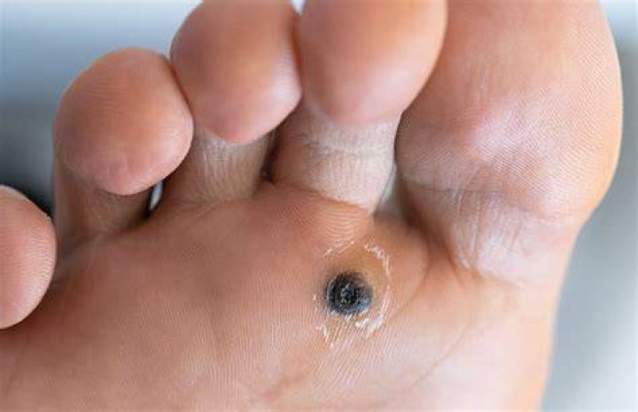 Pulled Out Plantar Wart Root: Understanding, Treatment, and Prevention