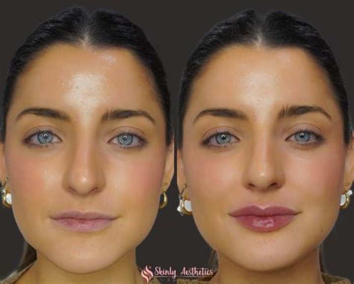 Sadie Sandler Lip Injections: What You Need to Know