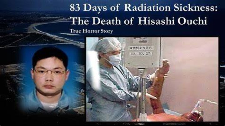 The Tragic Story of Hisashi Ouchi: A Case Study on Radiation Exposure