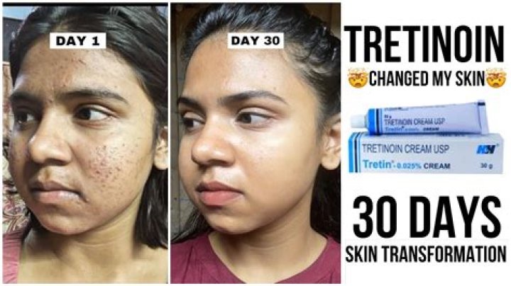 The Ultimate Guide to Achieving a Flawless Complexion with Tretinoin
