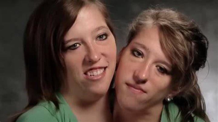 The Unfolding Story of Abby and Brittany Hensel: Addressing the Cause of Death Rumors