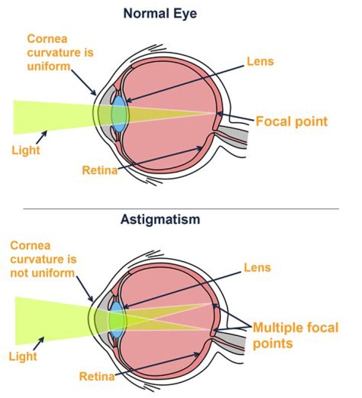 Understanding Astigmatism vs Normal Vision: A Comprehensive Guide