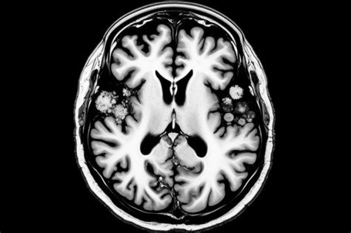 Understanding ATPL Disease: Symptoms, Causes, and Management