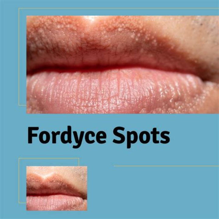 Understanding Fordyce Spots on Lips: Pictures and Insights