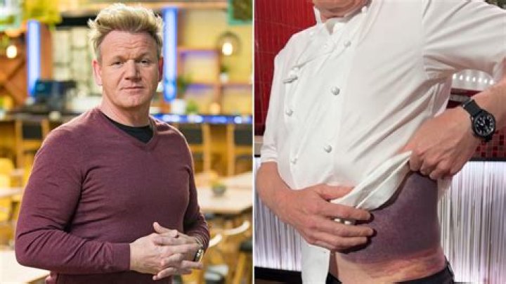 Understanding Gordon Ramsay's Bruise: What It Means and How It Affects His Career