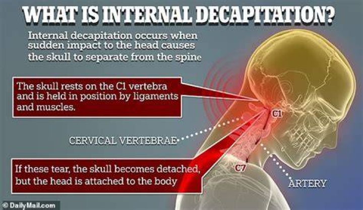 Understanding Internal Decapitation: Causes, Symptoms, and Treatments