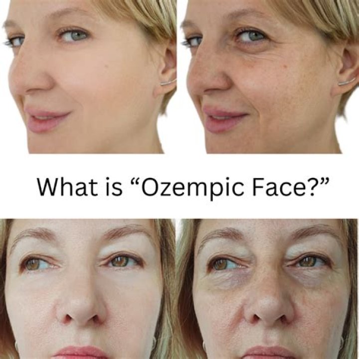Understanding Ozempic Face: Causes, Effects, and Solutions