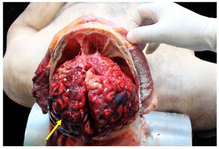 Understanding the Autopsy of Michael Hunter: A Comprehensive Overview