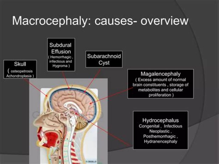 Understanding the Causes of Macrocephaly: A Comprehensive Guide