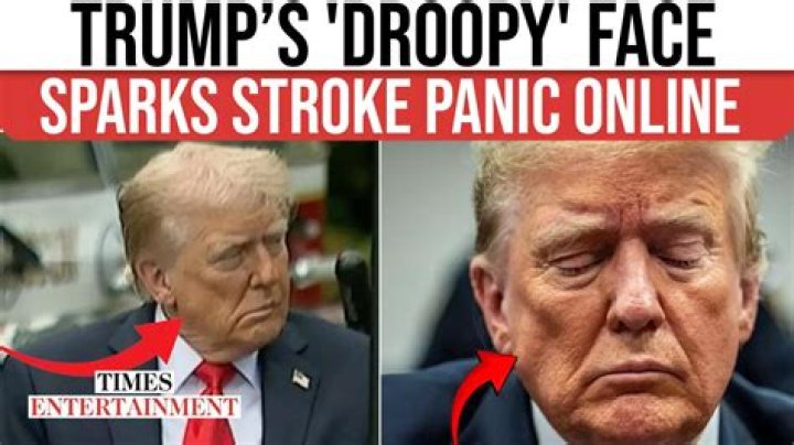 Unraveling the Mystery Behind Trump Stroke: What You Need to Know