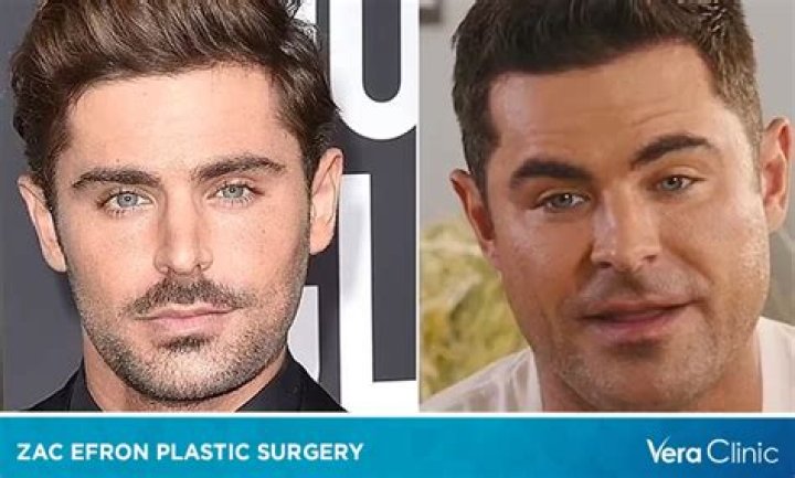 Unveiling the Truth: Zac Efron's Plastic Surgery Accident