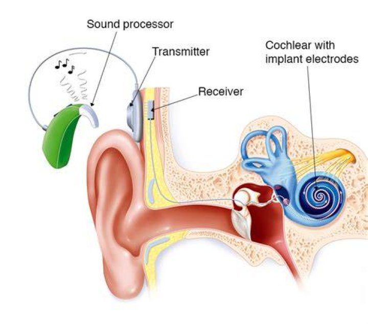 What Does a Cochlear Implant Sound Like? Understanding the Experience