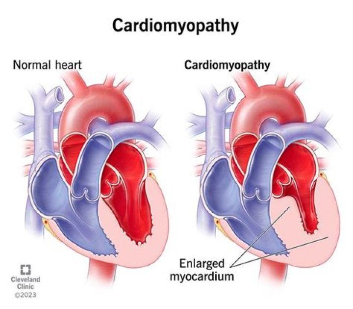 Winnie Has Cardiomyopathy: Understanding the Condition and Its Implications